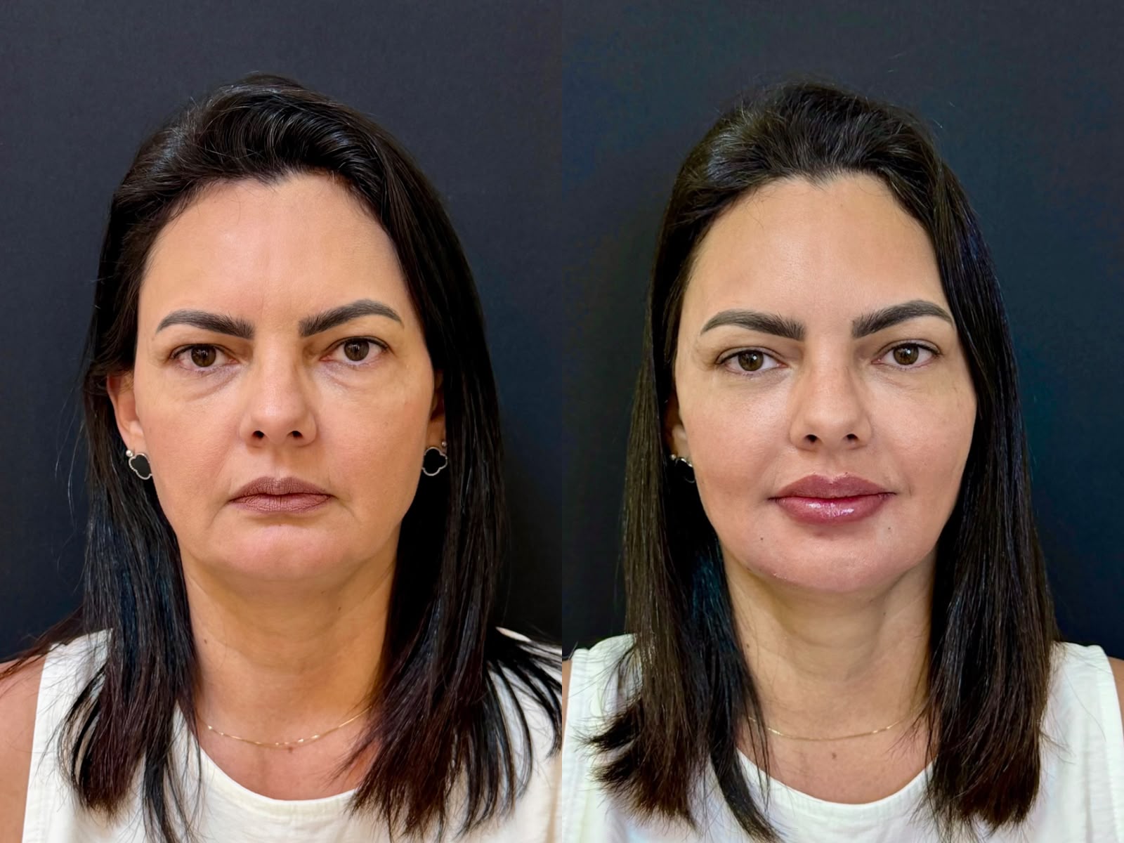 FACE SCULPT RP - Método Exclusivo de Planejamento Facial